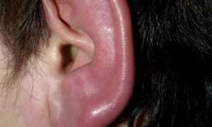 Что делать при обморожении уха?