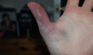 Травмы пальцев в волейболе