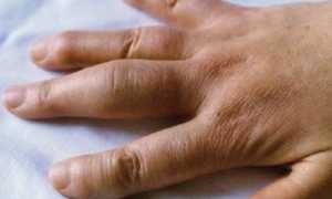Если ушиб палец на руке: что делать и как лечить в домашних условиях?