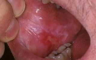 Изменения в полости рта при лучевой терапии